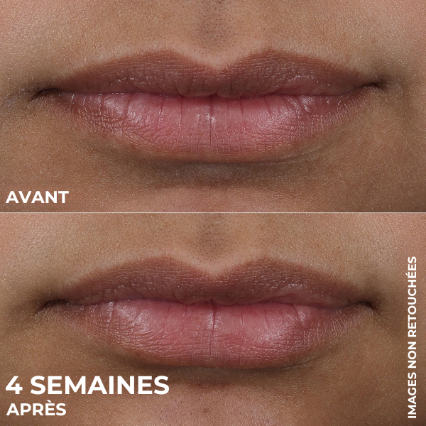 Lip Volumizer Elixa™