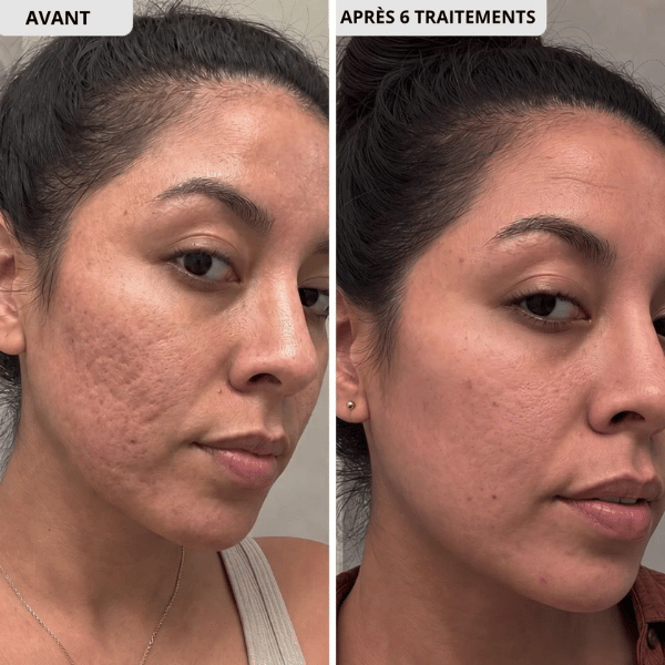 Kit Microneedling anti-acné