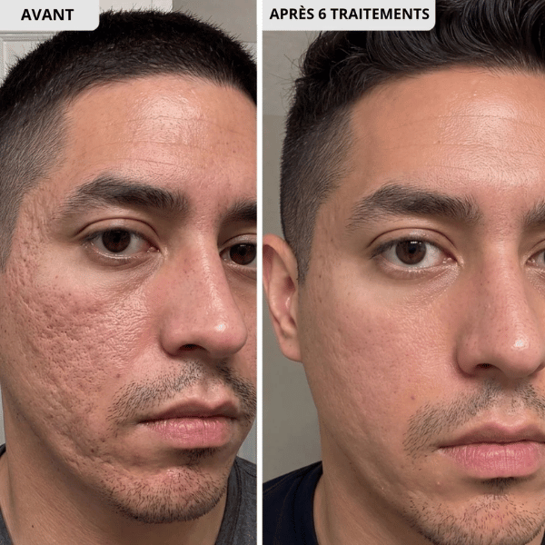 Kit Microneedling anti-acné